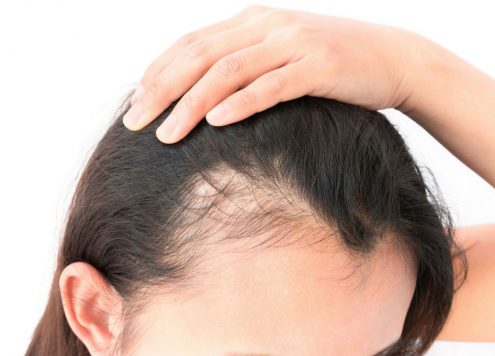 How to treat Baldness